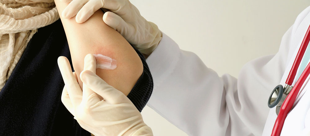 A doctor applying ointment on a patient's arm for Atopic Dermatitis